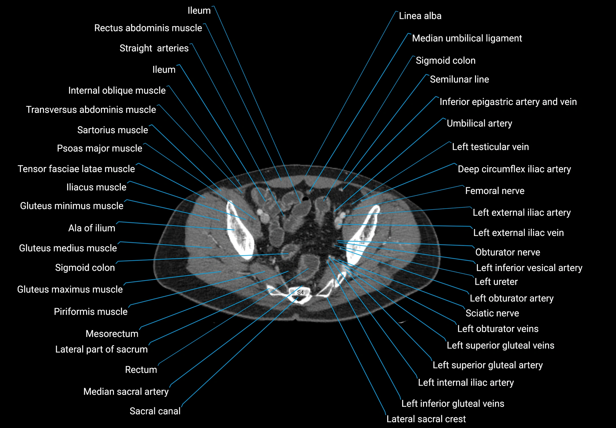 CT male pelvis axial cross sectional anatomy labelled radiology image -00167.webp